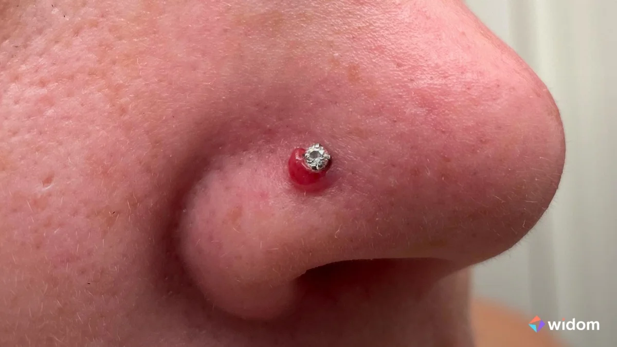 O que é Granuloma | Widom O que é Granuloma | Widom